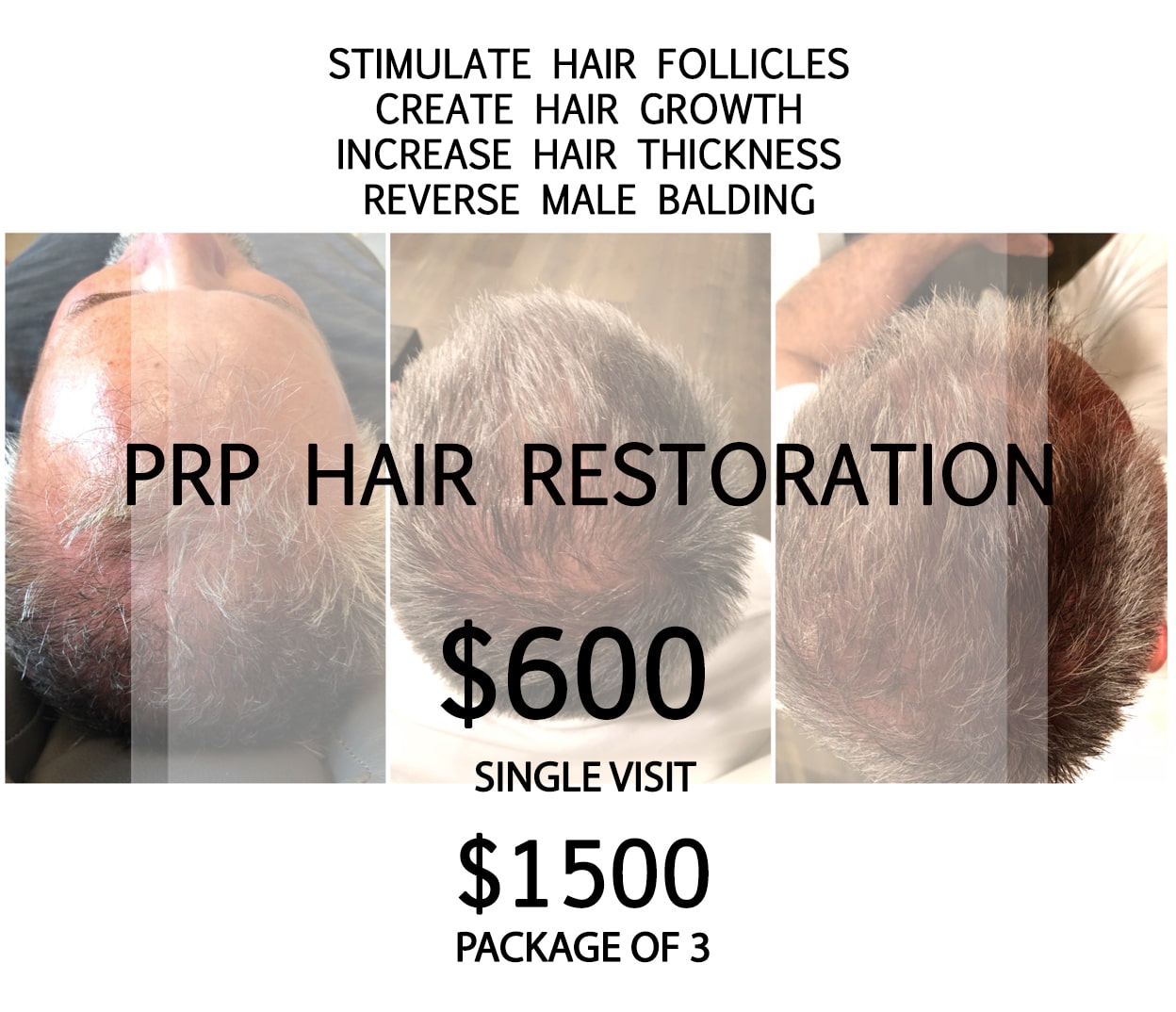 prp hair restoration ut beauty lab and laser